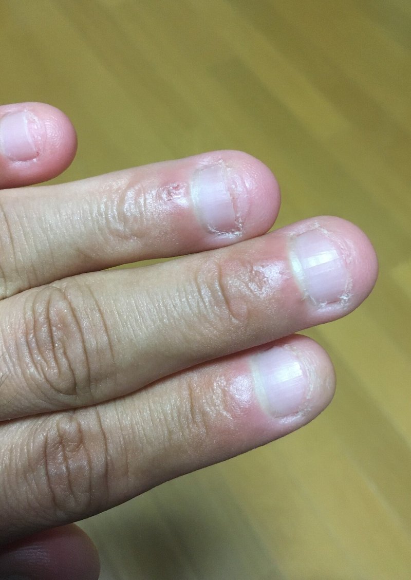 ストレスで爪噛みが再発した 空飛ぶペンギン Note ストレスで爪噛みが再発した 空飛ぶペンギン Note