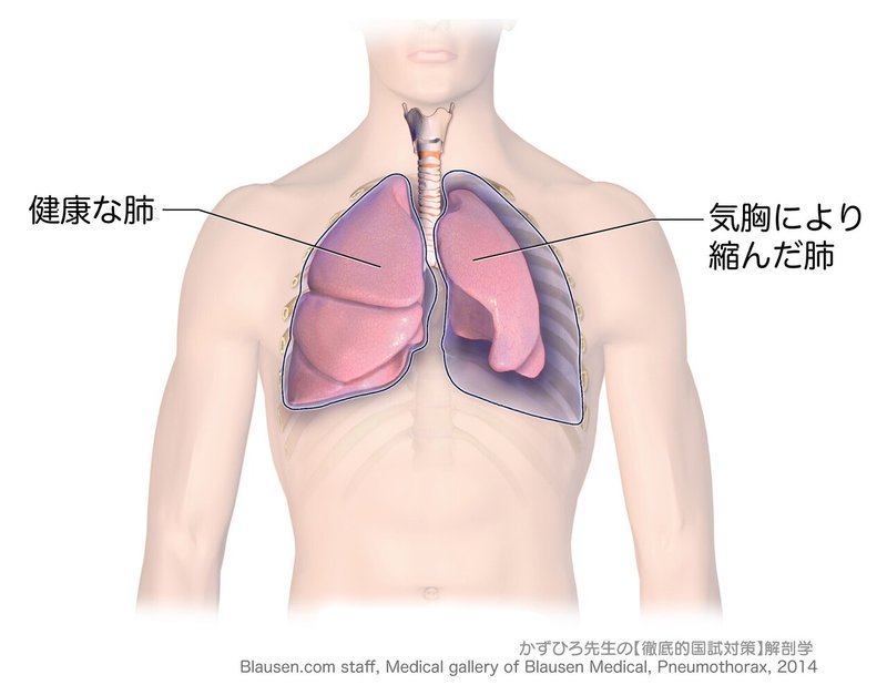 呼吸器系-34-気胸-SQ-図c