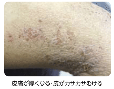 Q03 アトピー性皮膚炎は どんな病気 Dr モッシー Note