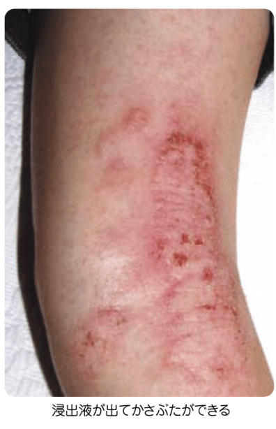 Q03 アトピー性皮膚炎は どんな病気 Dr モッシー Note