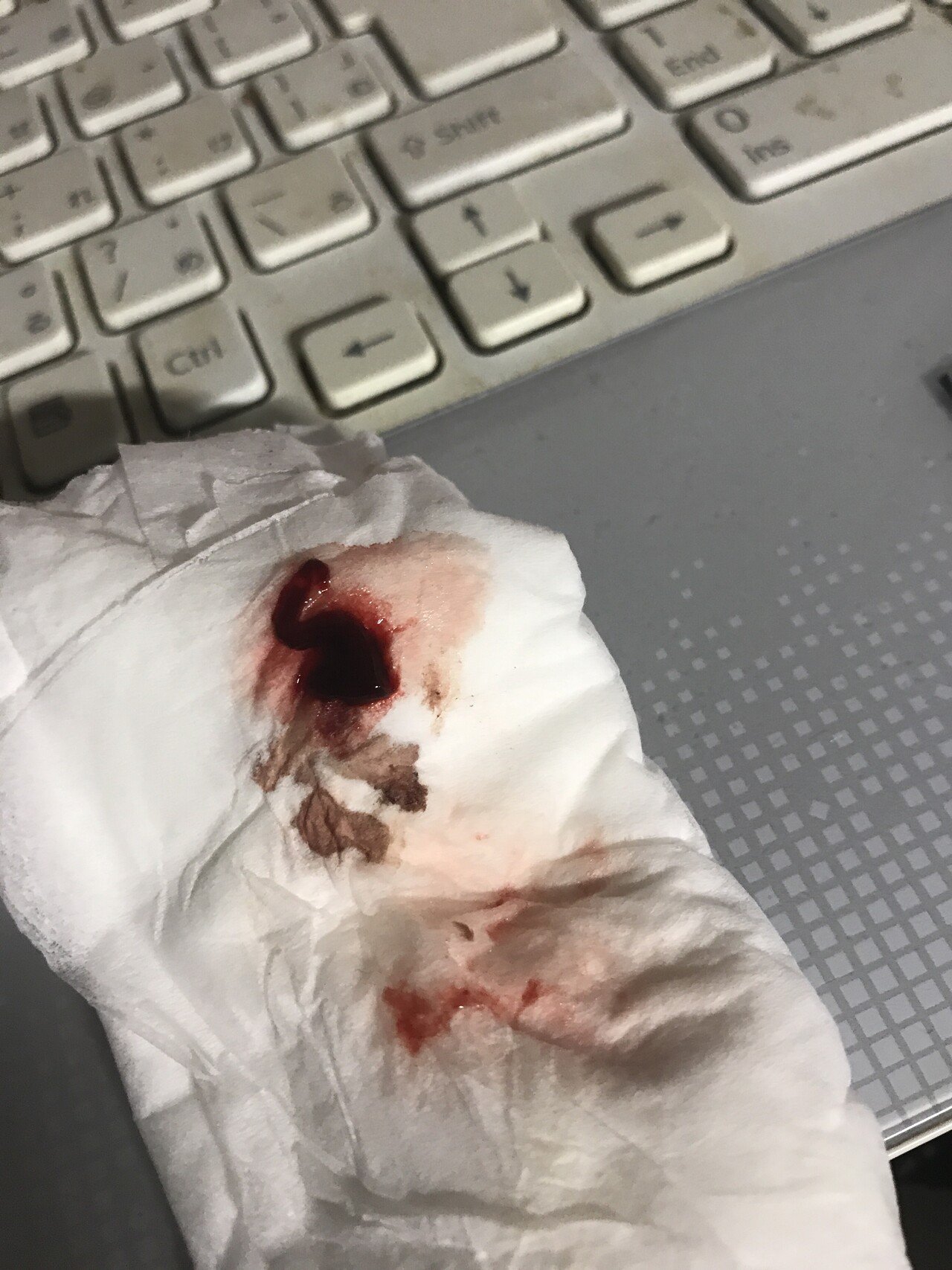 グロ注意 喉に違和感を感じて出してみたら 2日連続 で流血してます 粘膜弱ってるな M Note グロ注意 喉に違和感を感じて出してみたら 2日連続 で流血してます 粘膜弱ってるな M Note