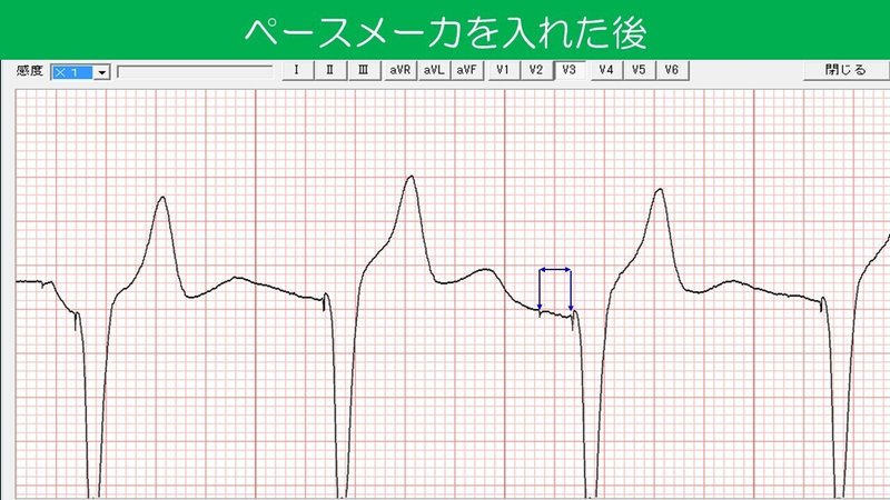 A-Vディレイ　埋め込み直後