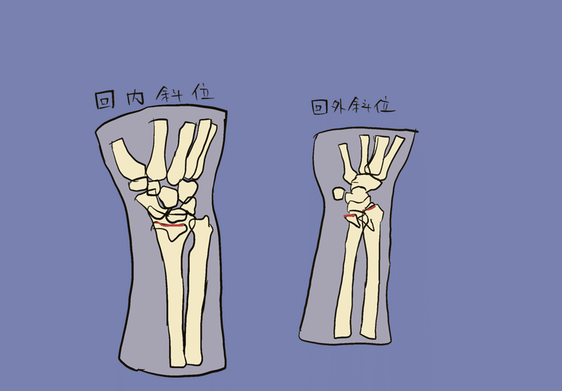 掌側バートンについて Radialkawasaki Note