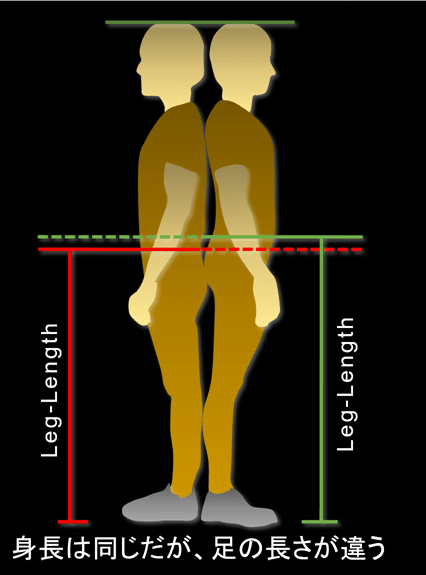 スクワットの最適フォームは大腿骨長で変化する 腰部と膝関節の傷害を予防する治療戦略 Lifting The Apex Note