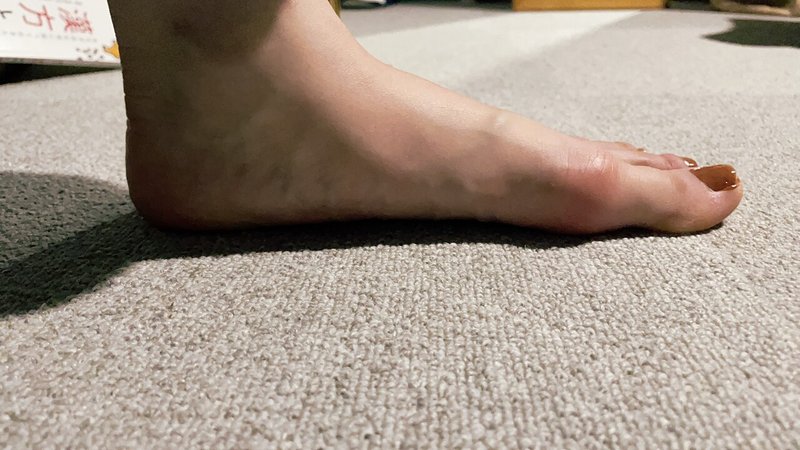 1日目 自力で外反母趾を治せるか ハルカ Nissu Note