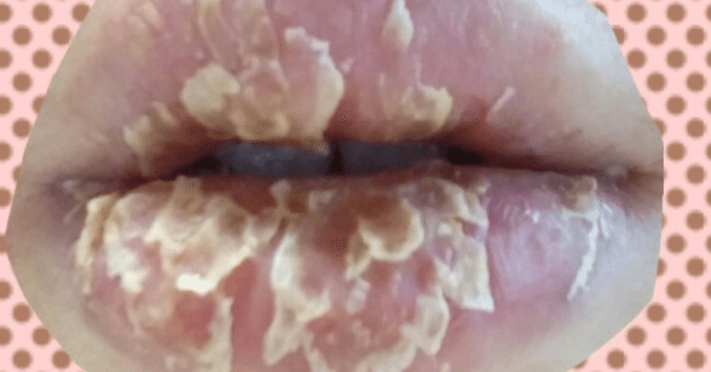 脱保湿11日目 口唇炎と闘う女 Note