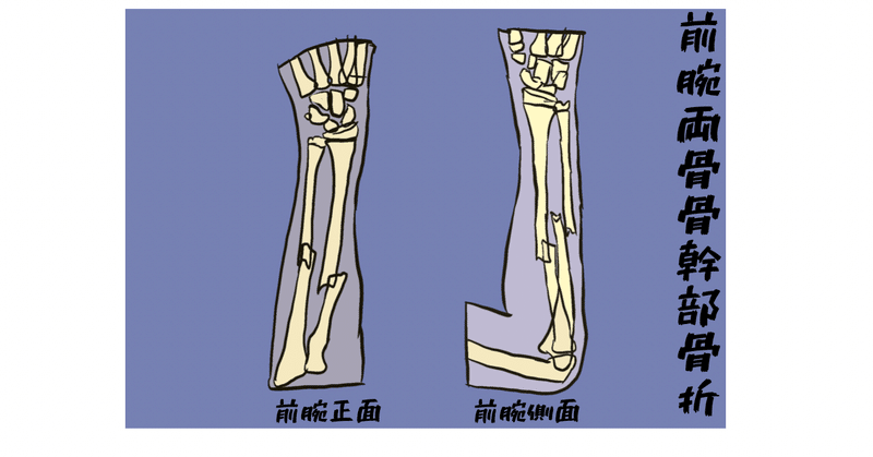 前腕両骨骨幹部骨折について Radialkawasaki Note