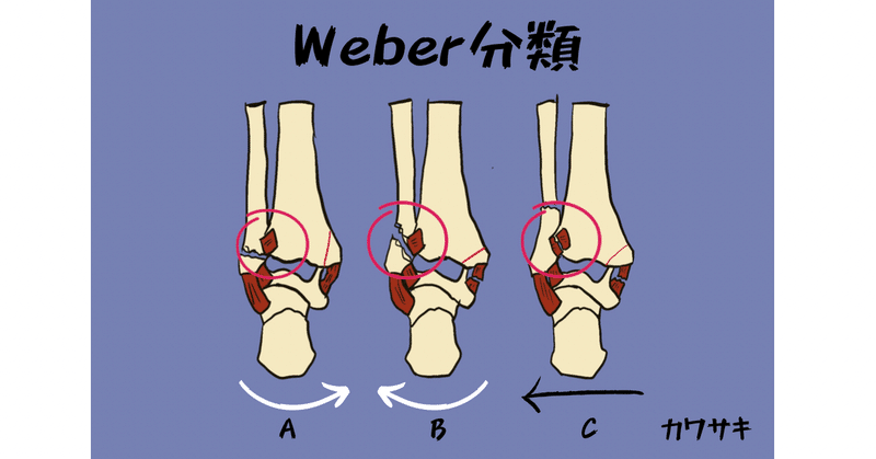 足関節脱臼骨折 Weberの分類を中心に Radialkawasaki Note