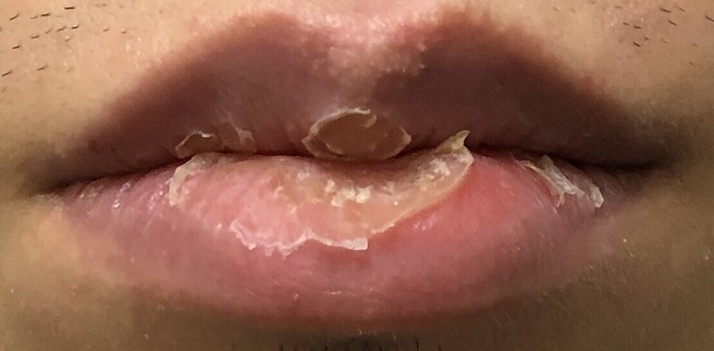 口唇炎が治るのに2年かかった話 剥脱性口唇炎 Exfoliative Cheilitis Io Note 口唇炎が治るのに2年かかった話 剥脱性口唇炎 Exfoliative Cheilitis Io Note