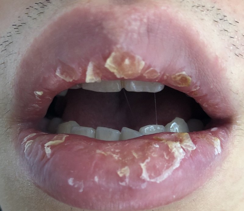 口唇炎が治るのに2年かかった話 剥脱性口唇炎 Exfoliative Cheilitis Io Note