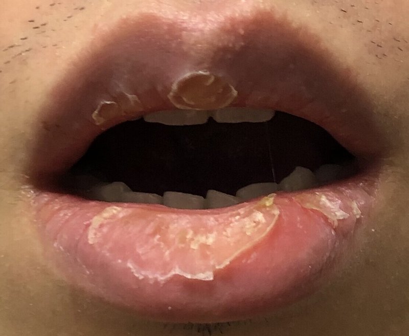 口唇炎が治るのに2年かかった話 剥脱性口唇炎 Exfoliative Cheilitis Io Note
