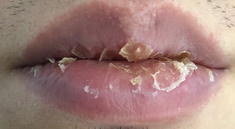 口唇炎が治るのに2年かかった話 剥脱性口唇炎 Exfoliative Cheilitis Io Note 口唇炎が治るのに2年かかった話 剥脱性口唇炎 Exfoliative Cheilitis Io Note