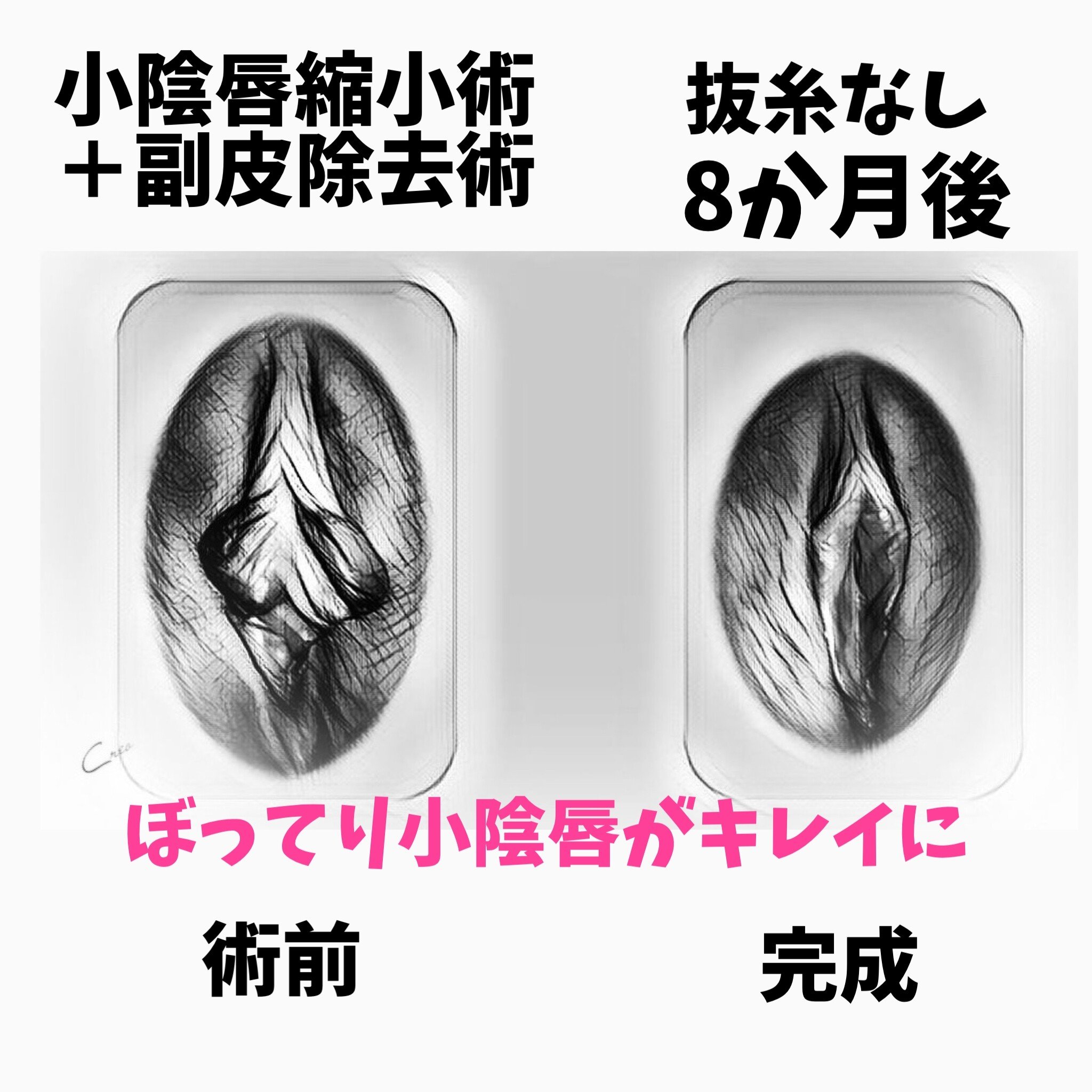 両側小陰唇縮小術の症例写真イラスト化 女性のお悩み 藤田先生 Note 両側小陰唇縮小術の症例写真イラスト化 女性のお悩み 藤田先生 Note