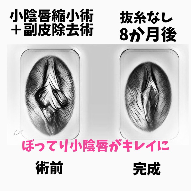 両側小陰唇縮小術の症例写真イラスト化 女性器女医 藤田先生 Note