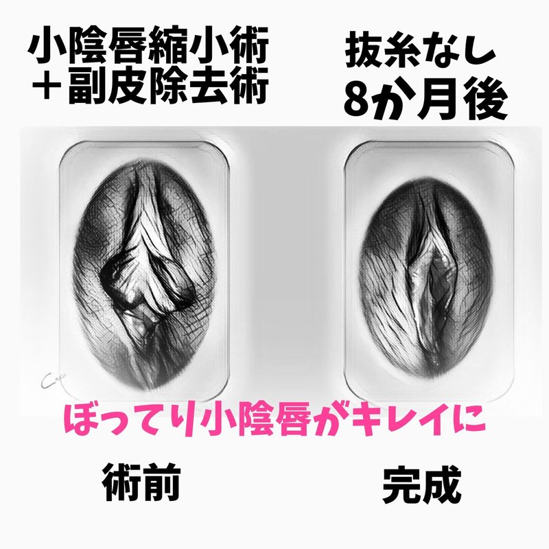 両側小陰唇縮小術の症例写真イラスト化 女性器女医 藤田先生 Note 両側小陰唇縮小術の症例写真イラスト化 女性器女医 藤田先生 Note