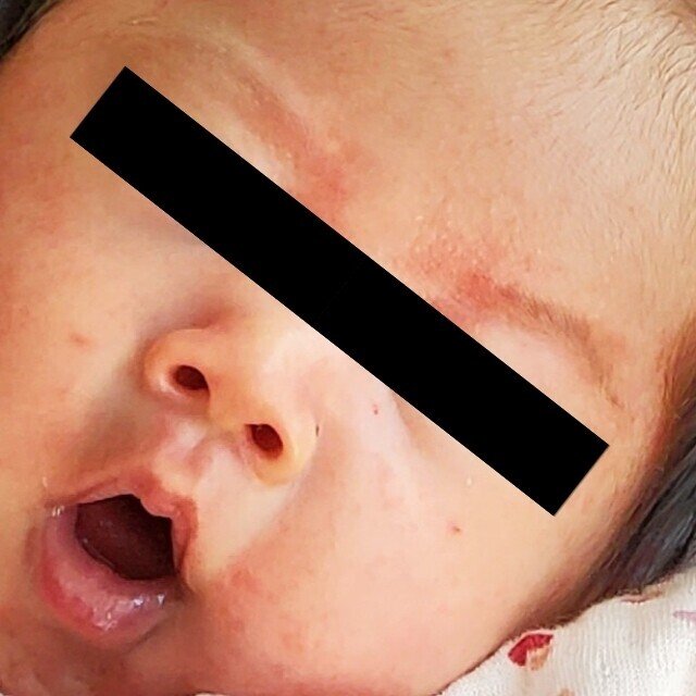 乳児湿疹対策 Shellm Note 乳児湿疹対策 Shellm Note