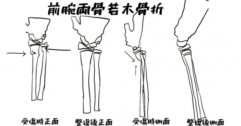 前腕両骨遠位部骨折について Radialkawasaki Note