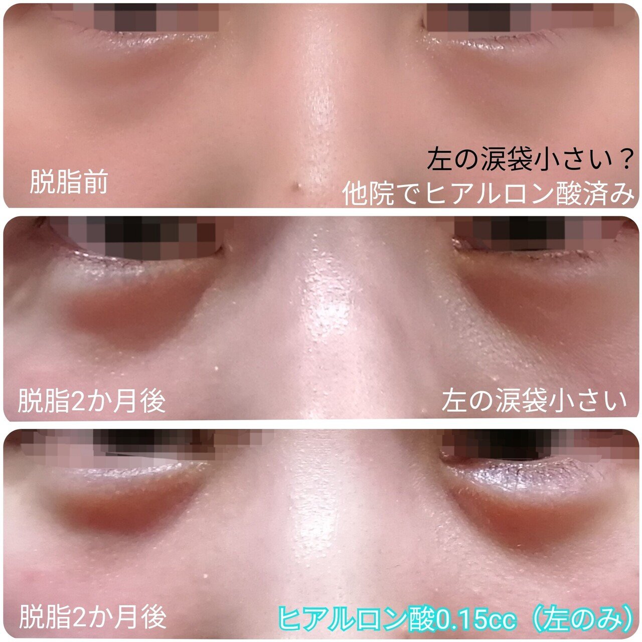 涙袋にヒアルロン酸が入ったまま脱脂をするとどうなるか しぶけん美容外科医 Note 涙袋にヒアルロン酸が入ったまま脱脂をするとどうなるか しぶけん美容外科医 Note