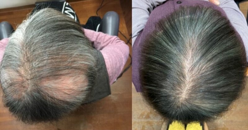 薄毛女性 の新着タグ記事一覧 Note つくる つながる とどける