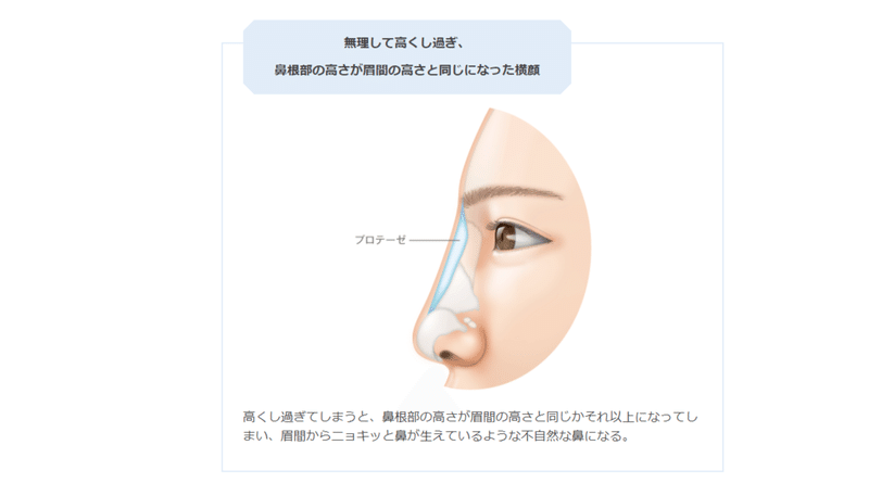 整形前の人も後の人も知っておきたい 鼻のプロテーゼがバレるとき 高須クリニック公式 Note 整形前の人も後の人も知っておきたい 鼻のプロテーゼがバレるとき 高須クリニック公式 Note