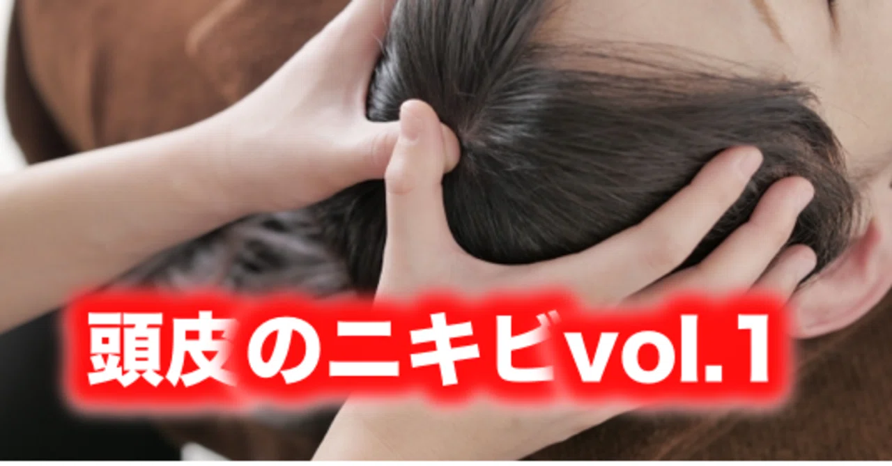 頭皮のニキビvol 1 片柳ちひろ ニキビ博士 Note