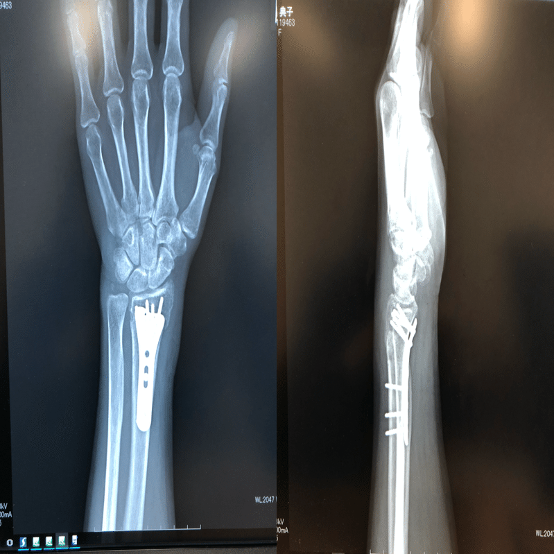 右手首骨折顛末：一ヶ月半過ぎました｜大隅典子の仙台通信note