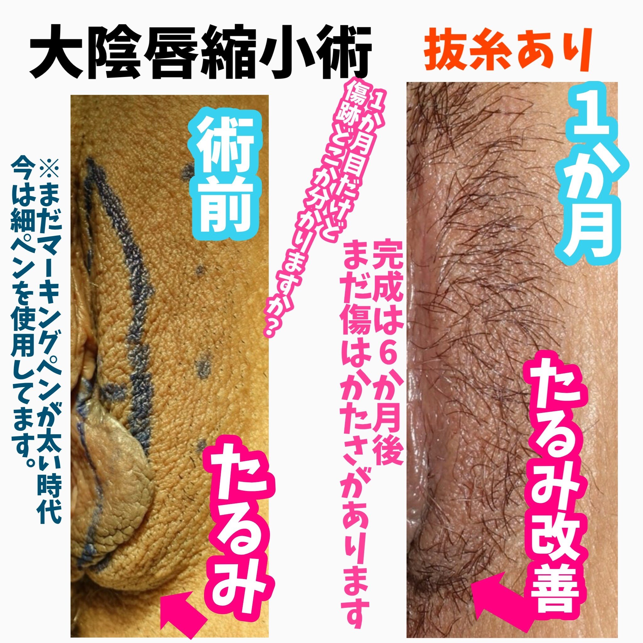 大陰唇縮小術の傷跡写真 大陰唇のたるみが気になる方へ 女性器女医 藤田先生 Note 大陰唇縮小術の傷跡写真 大陰唇のたるみが気になる方へ 女性器女医 藤田先生 Note