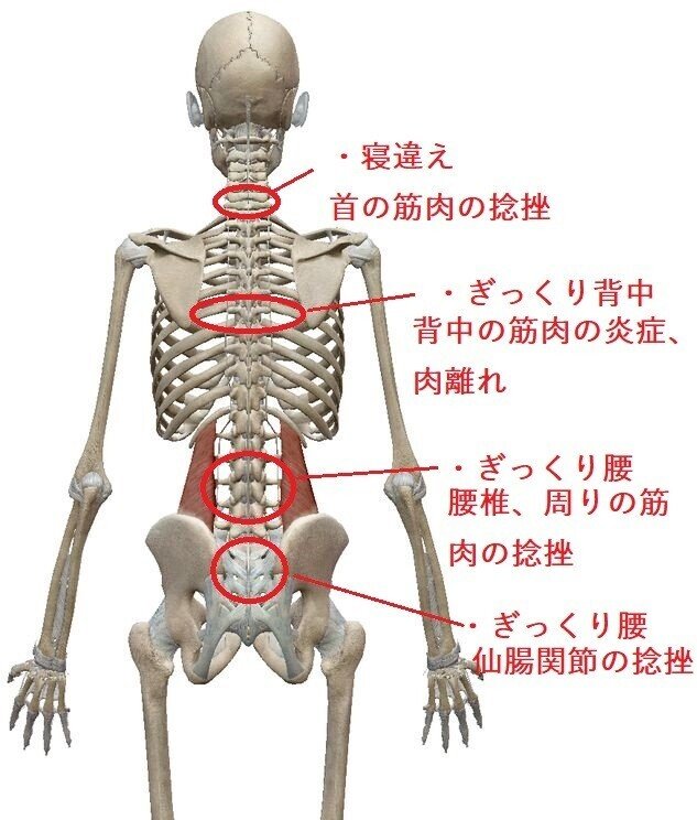 ぎっくり背中の症状と処置 鷹野琢磨 Koa Gym Trainer Note