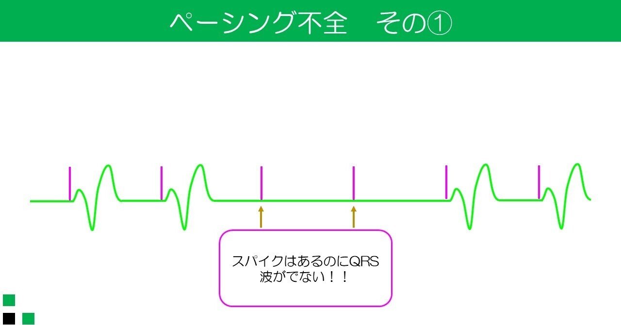 ペーシング不全｜ゆるひも@CE