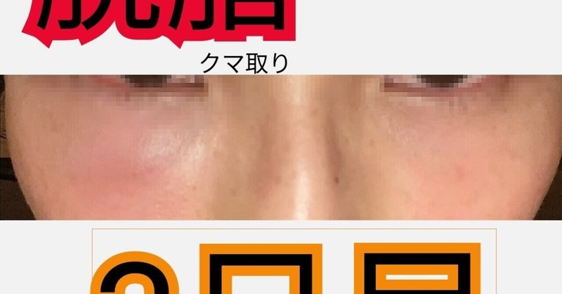 目の下の手術してから３日目の腫れ具合 30代女性脱脂後 しぶけん美容外科医 Note