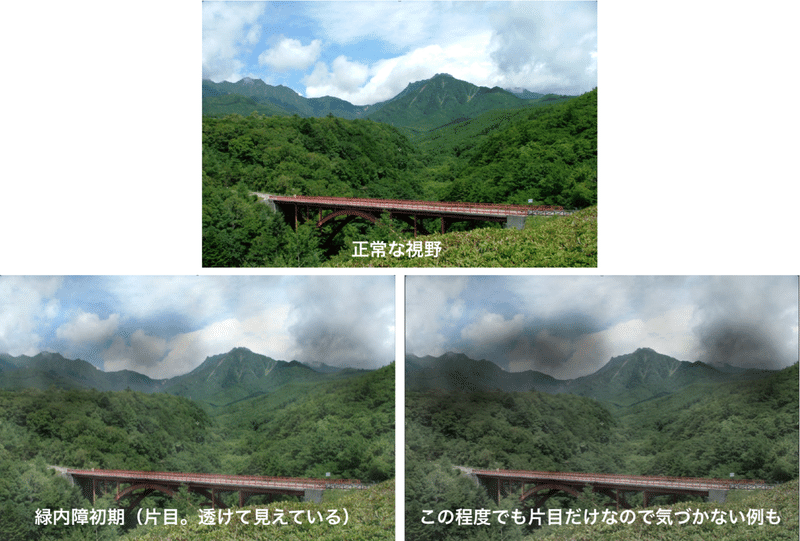 緑内障で 白内障手術と同様の眼内レンズにしたら こうなりました その1 佐久間 功 Note 緑内障で 白内障手術と同様の眼内レンズにしたら こうなりました その1 佐久間 功 Note