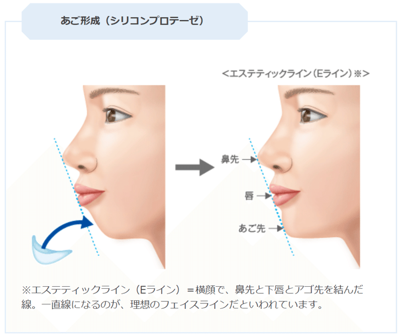 顎プロテーゼの痛み 美容整形はどれくらい痛い 高須クリニック公式 Note 顎プロテーゼの痛み 美容整形はどれくらい痛い 高須クリニック公式 Note