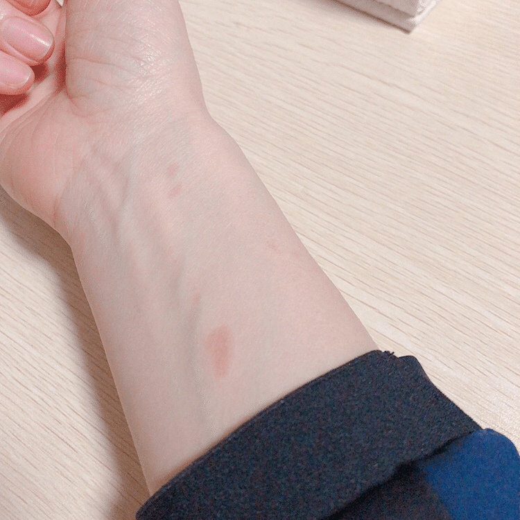 やけど用 アロマ対処法 Goldlight22 Note