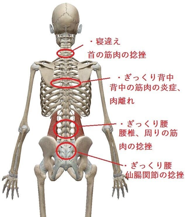 ぎっくり腰の症状と処置 鷹野琢磨 Koa Gym Trainer Note