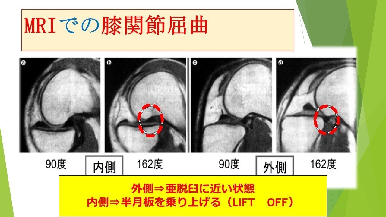 膝関節屈曲の様子をmriでみてみると 内側と外側で大腿骨の動きの違いがわかるかと思います 大腿骨の内側は半月板を乗り上げて 外側は半月板を乗り越え脛骨との接触面も少なくなります 膝関節の深屈曲にはが大 ガクトレ Note
