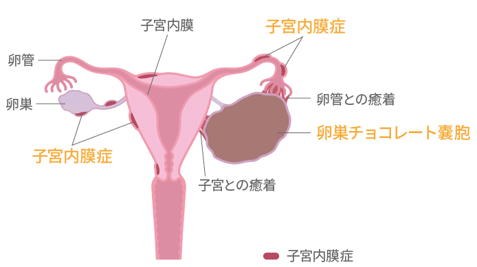 子宮内膜症 3 治ることのない病気 Genmai100 わたしとしきゅう Note