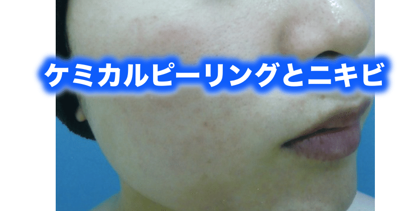 ケミカルピーリングとニキビ 片柳ちひろ ニキビ博士 Note