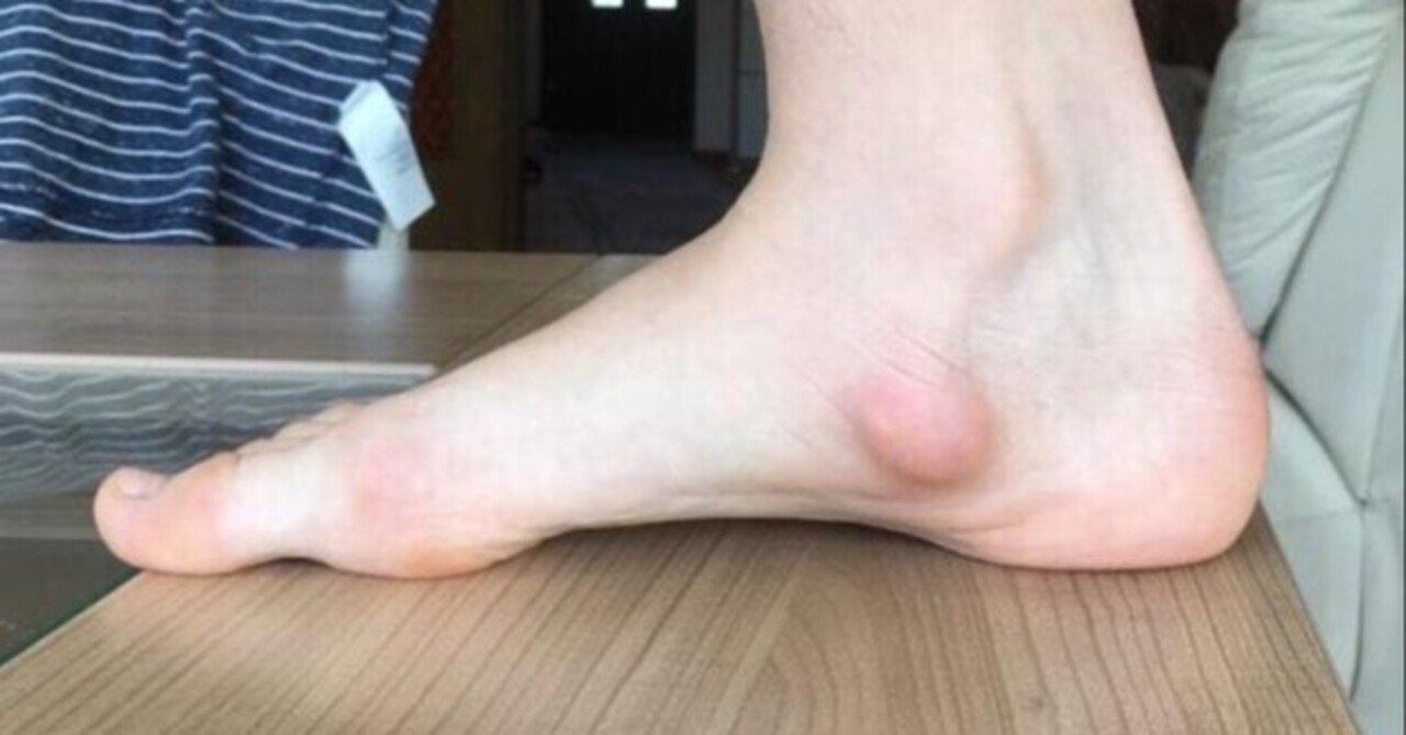 スケーターの足の悩み 有痛性外脛骨 スケートインソール株式会社 Note スケーターの足の悩み 有痛性外脛骨 スケートインソール株式会社 Note