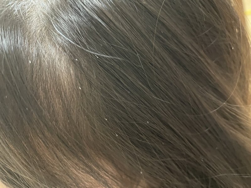 頭ジラミ発見から３日目 川瀬ゆき Note