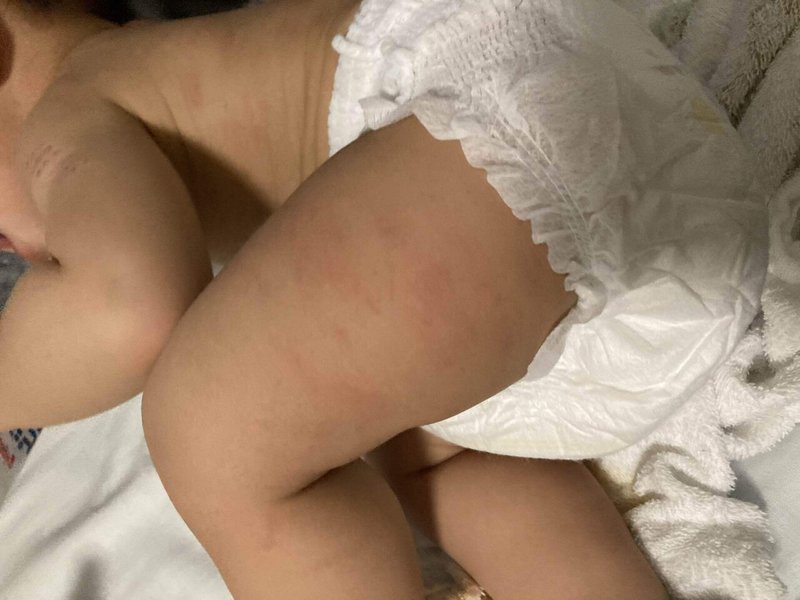 症例写真あり 入浴後の赤ちゃんの湿疹 赤あざ について 普通な私生活 にしくる Note 症例写真あり 入浴後の赤ちゃんの湿疹 赤あざ について 普通な私生活 にしくる Note