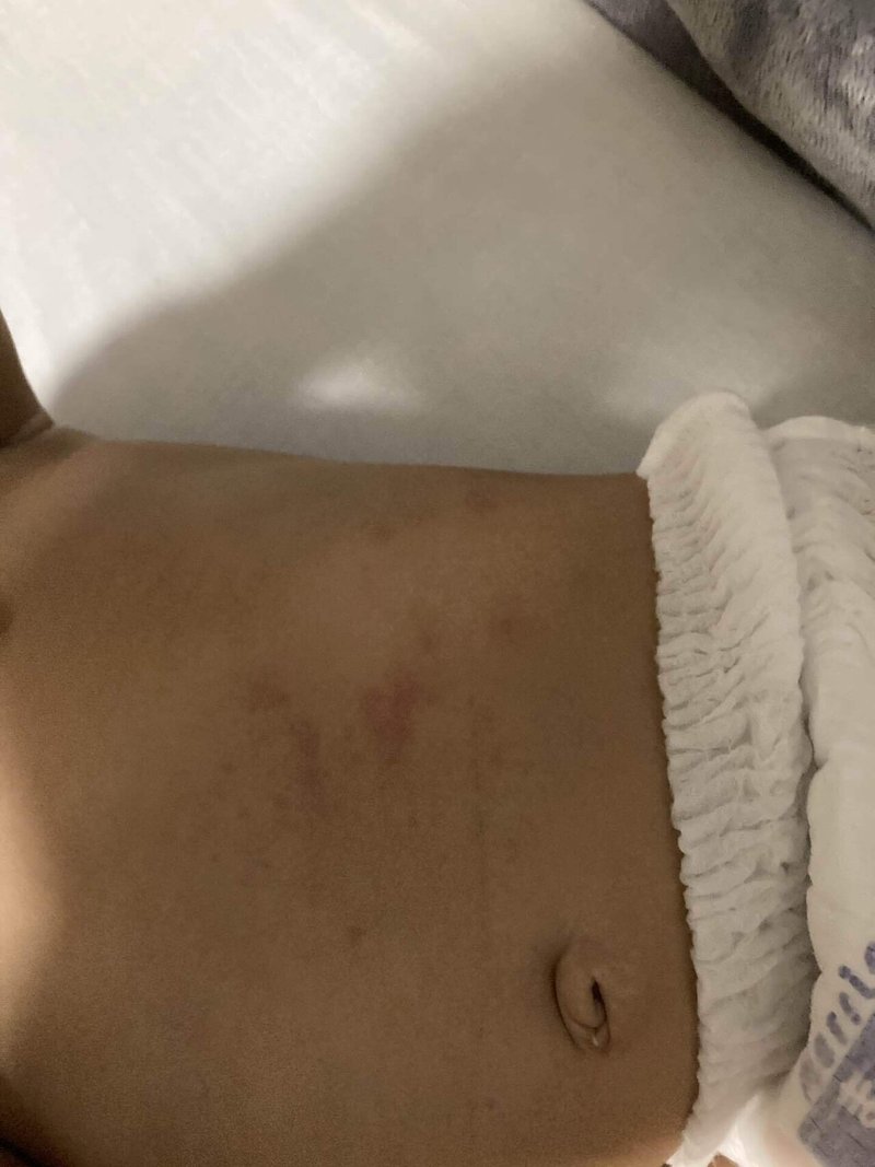 症例写真あり 入浴後の赤ちゃんの湿疹 赤あざ について 普通な私生活 にしくる Note 症例写真あり 入浴後の赤ちゃんの湿疹 赤あざ について 普通な私生活 にしくる Note