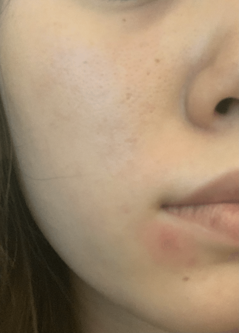 皮膚科で処方されるニキビの薬はダウンタイムがある 3種類使ってみたレポート ベピオゲル 2 5 エピデュオゲル15g ダラシンtゲル1 でこたん Note