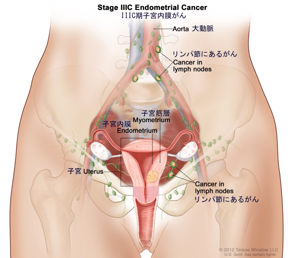 ロボット支援下 腹腔鏡下子宮悪性腫瘍手術 -work.07-｜Yama