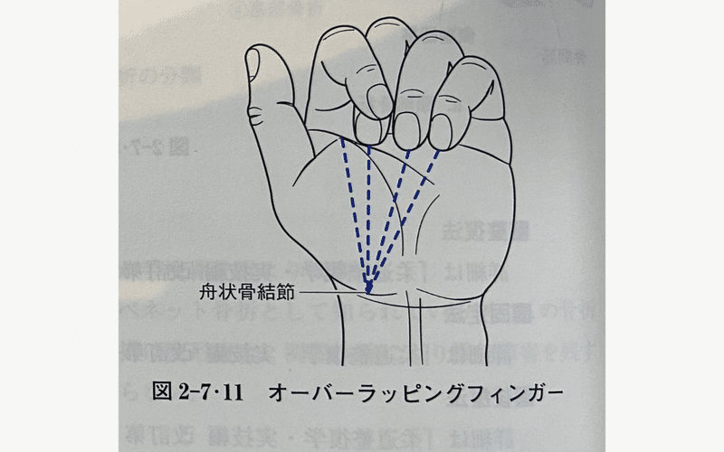 中手骨骨幹部斜 螺旋 骨折について考える なおや 気ままなセラピスト Note