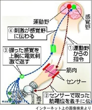 筋電義手