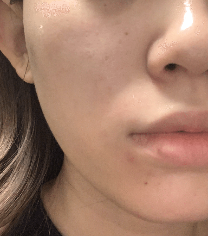 皮膚科で処方されるニキビの薬はダウンタイムがある 3種類使ってみたレポート ベピオゲル 2 5 エピデュオゲル15g ダラシンtゲル1 でこたん Note