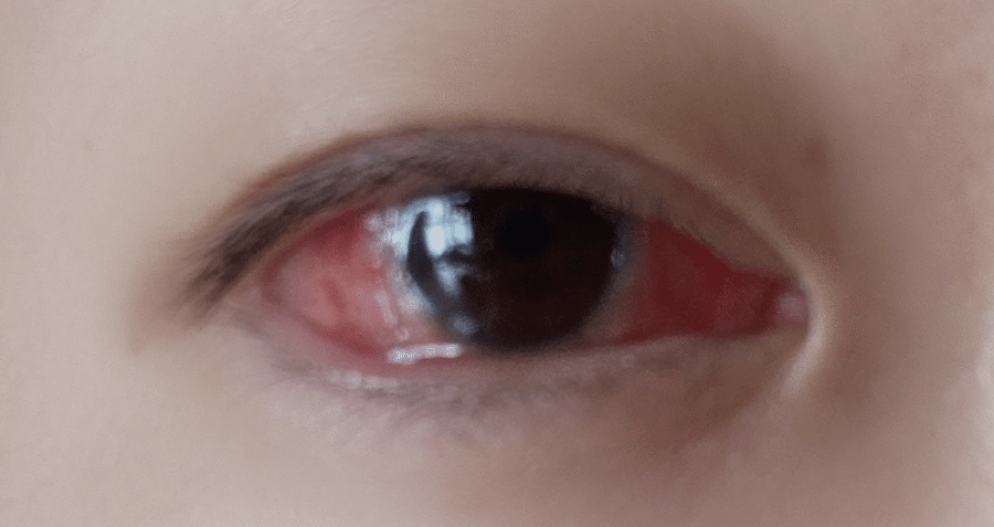 斜視手術経過 6日目少し心配な部分が Maaal Note 斜視手術経過 6日目少し心配な部分が Maaal Note