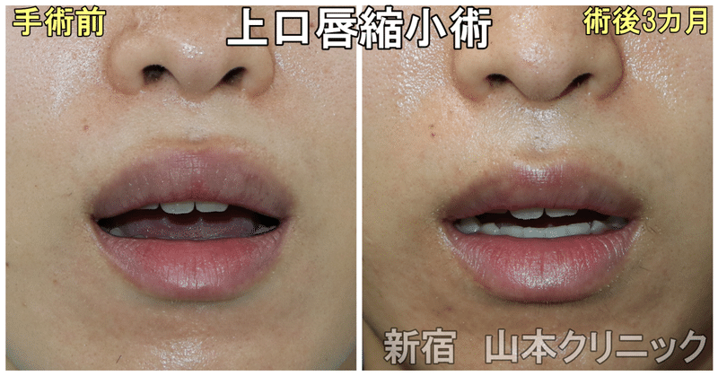 唇切ったら激腫れ 口唇縮小術 新宿 山本クリニック Note
