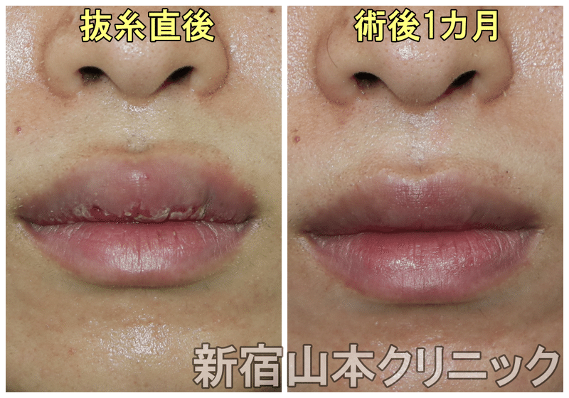唇切ったら激腫れ 口唇縮小術 新宿 山本クリニック Note