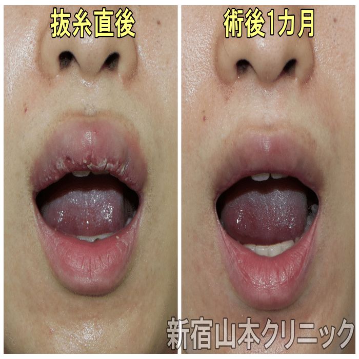 唇切ったら激腫れ 口唇縮小術 新宿 山本クリニック Note